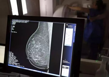 Ministério da Saúde passa a recomendar mamografia a partir dos 40 anos